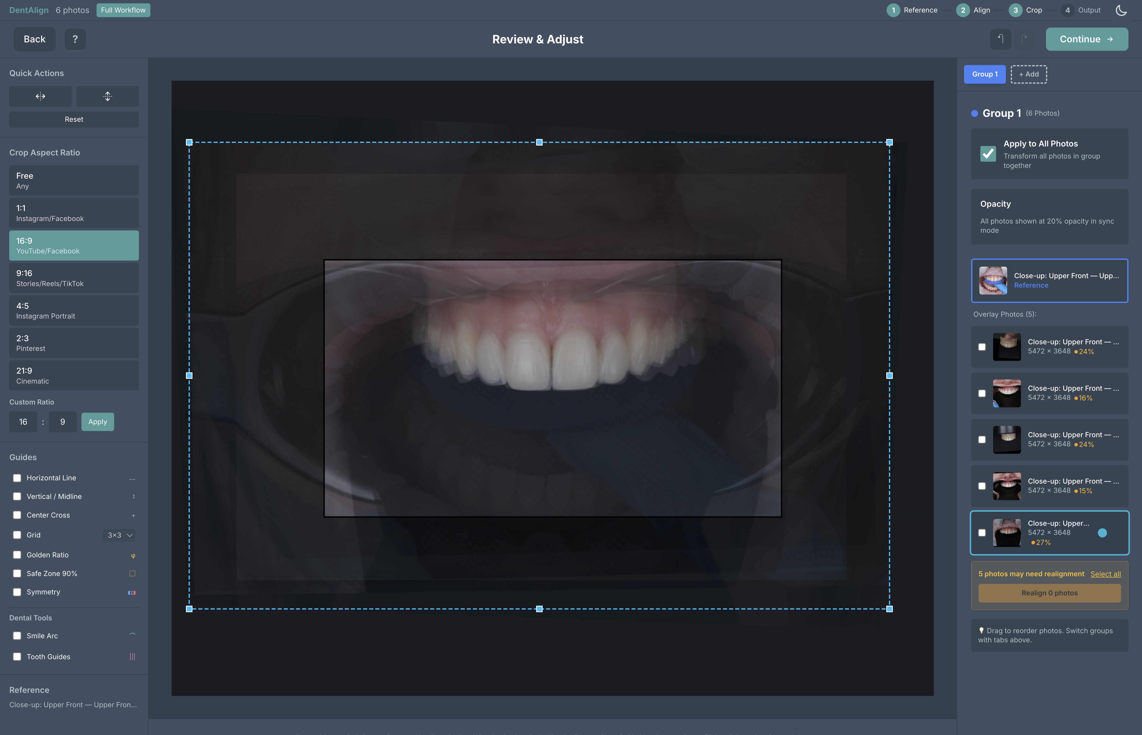 DentAlign alignment review