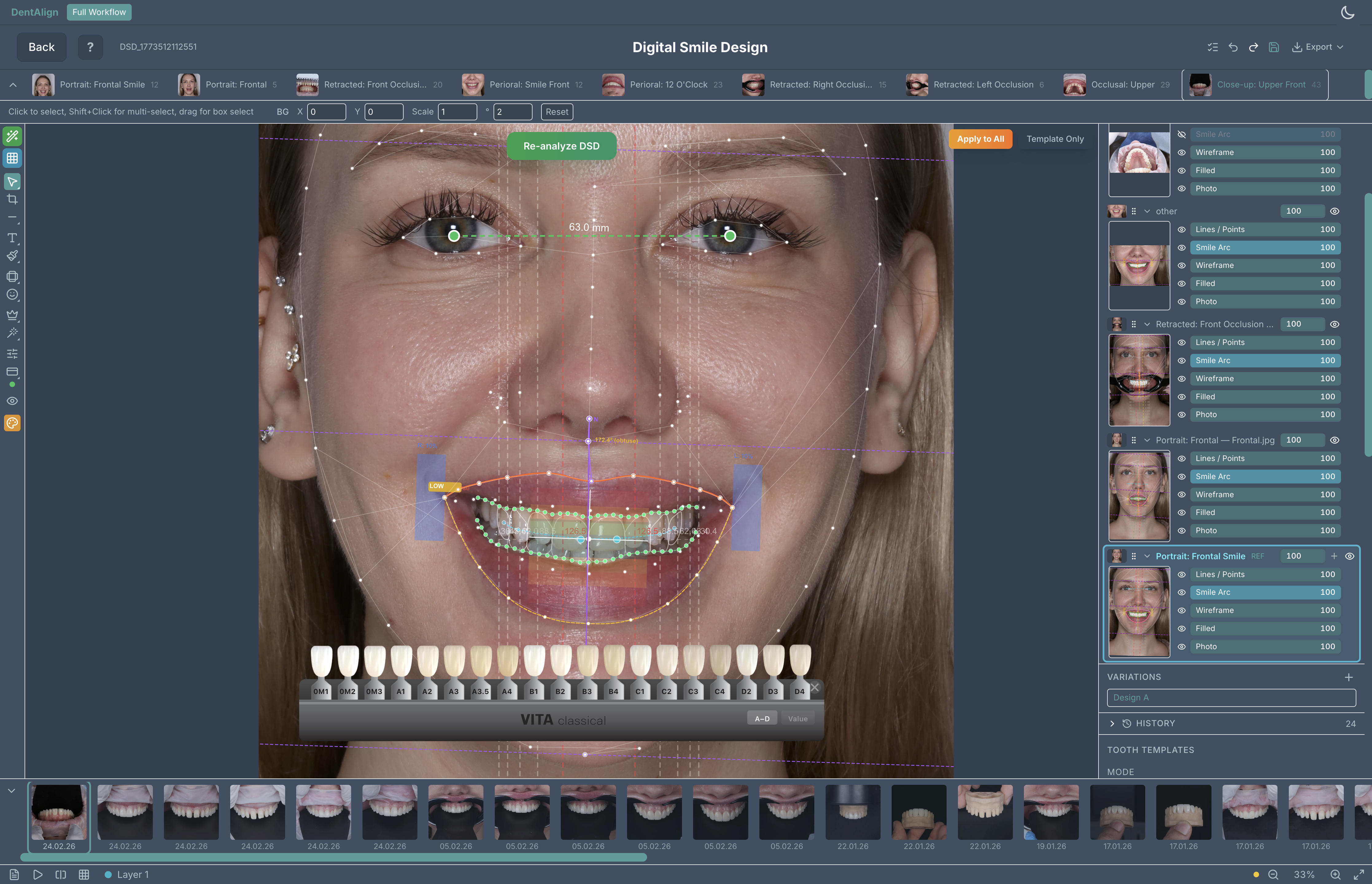 DentAlign Digital Smile Design